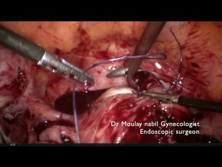 Challenging Myomectomy (11cm Submucous Uterine Myoma)