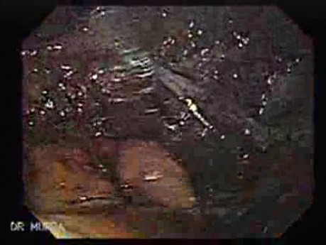 Gastric Varices Rosettes Formation (3 of 22)