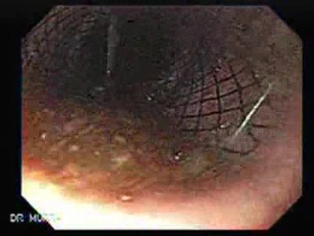 Esophageal Stricture - Stenting
