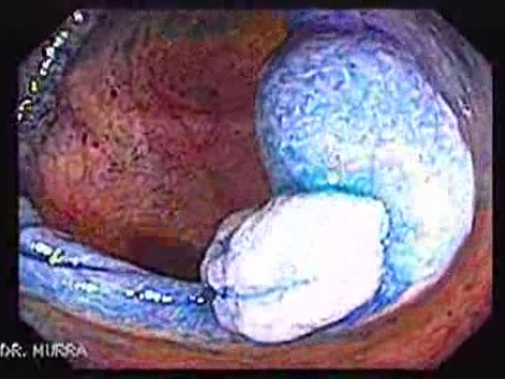Sessile Tubulovillous Adenoma (4 of 13)