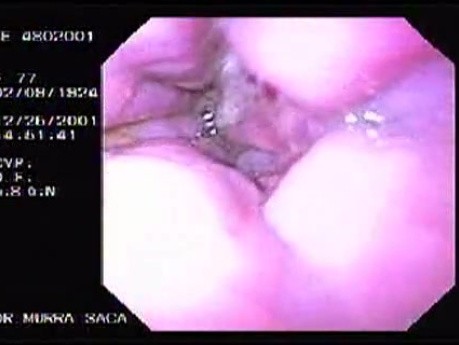 Hemorrhage due status post rubber band ligation of esophageal varices (2 of 25)