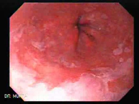 Barrett's Esophagus of long segment -Barrett's tongue (10 of 11)