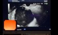 Thoracoabdominal Pseudocyst Endoscopic Drainage