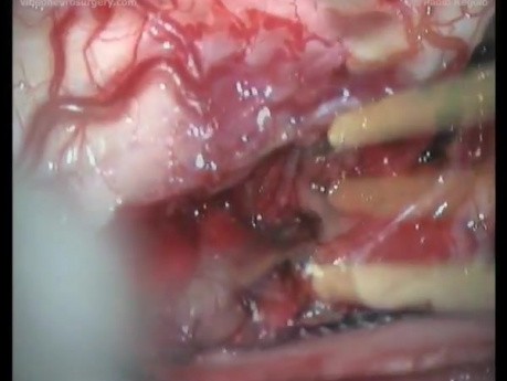 Cervical Intramedullary Astrocytoma - Posterior Approach