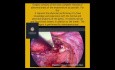 Endometriosis Booklet
