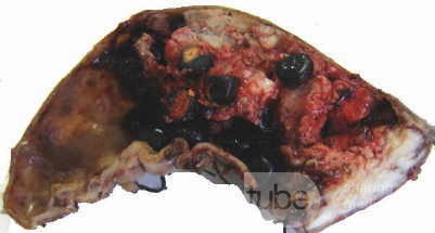Gallbladder Adenocarcinoma and litiasis (4 of 13)