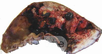 Gallbladder Adenocarcinoma and litiasis (4 of 13)