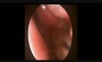 Sphenoid Sinus Pyocele