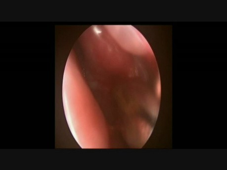 Sphenoid Sinus Pyocele