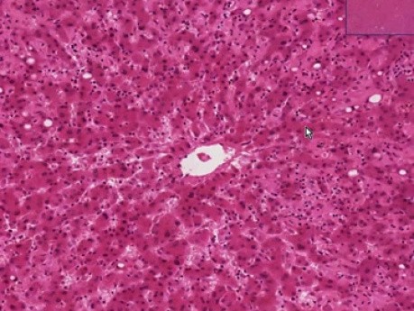 Amyloidosis - Histopathology - Liver