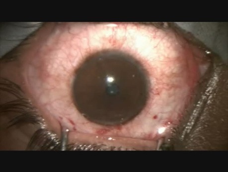Surgery in a Case of Duane Retraction Syndrome