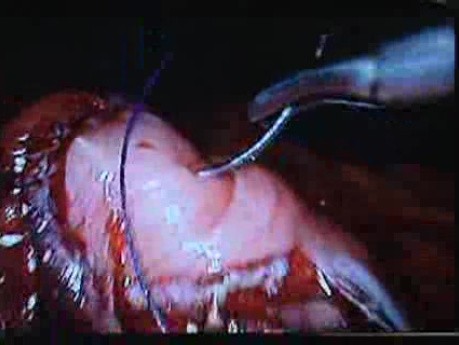 Jejunal Gastrointestinal Stromal tumor (GIST) (53 of 86)