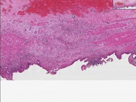 Chronic cholecystitis