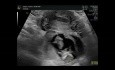 Ectopic Pregnancy