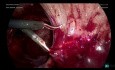 Laparoscopic Enterolysis Removal of Left Hydrosalpingx (Part 3)