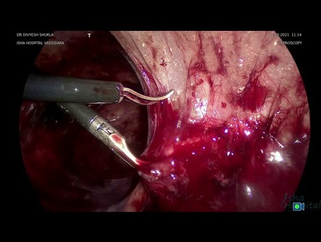 Laparoscopic Enterolysis Removal of Left Hydrosalpingx (Part 3)