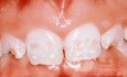 Dental Hypoplasia