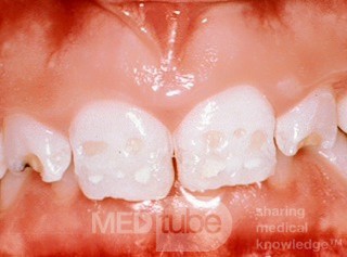 Dental Hypoplasia
