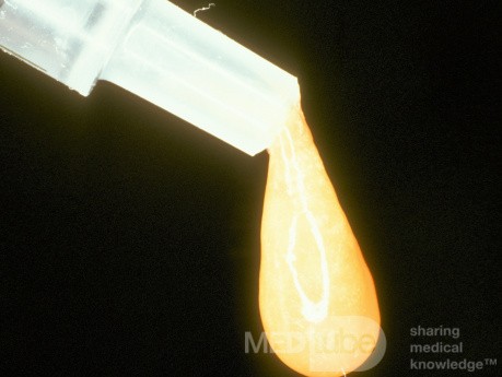 Mucoid Otitis Media Middle Ear Aspirate