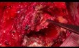 Redo Aortic Root Surgery 3 