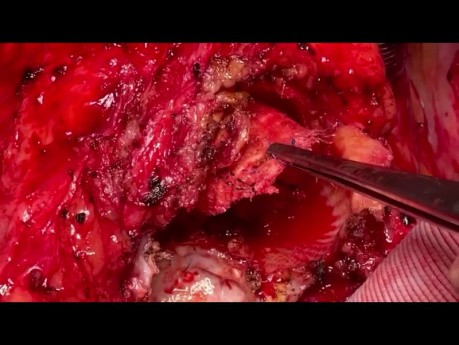 Redo Aortic Root Surgery 3 