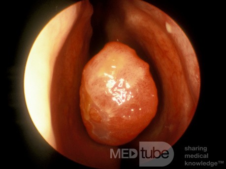 Elongated Middle Turbinate