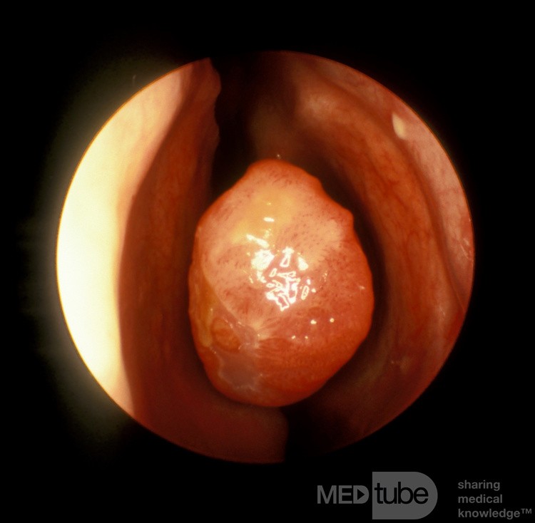 Elongated Middle Turbinate