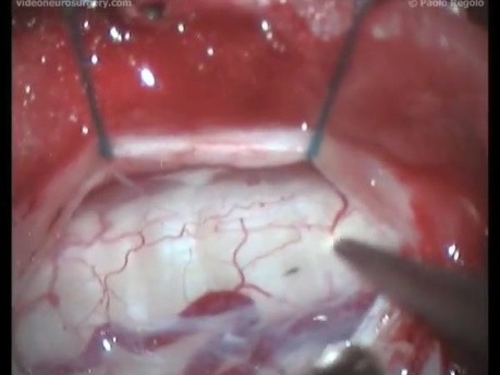 Syringomyelia - Thoracic Subarachnoid Shunting