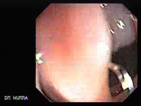 Colonoscopic Polypectomy (11 of 23)