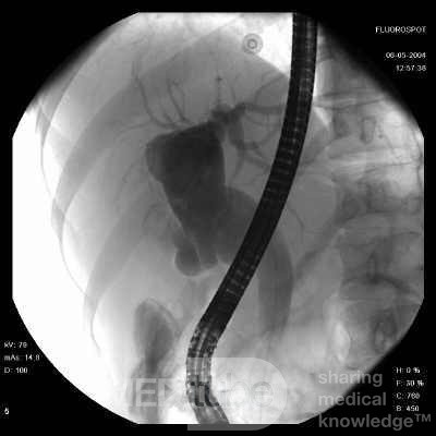 Adenocarcinoma of the head of the Pancreas that infiltrates
 the wall of duodenum (10 of 10)