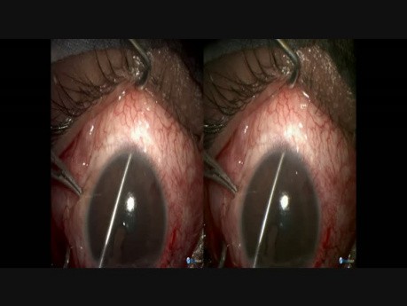 Failed Anterior Filtration in a VR Surgery Case, Reverse Cyclodialysis Done