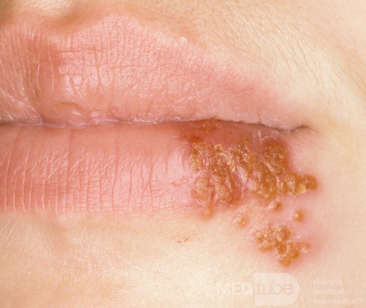 Herpes Simplex Lower Lip [resolving]