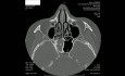 Sphenoid Sinus Fungus Ball - Endoscopic Surgery