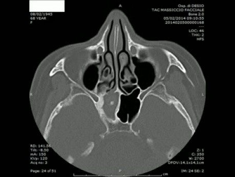 Sphenoid Sinus Fungus Ball - Endoscopic Surgery