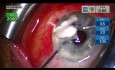 Vitreous Blocked Glaucoma Shunt Tube