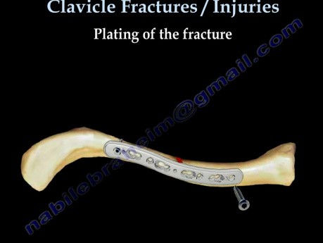 Clavicle Fracture - Video Lecture