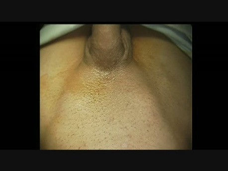 Laparoscopic Groin Hernia Repair, Steps: Percutaneous Identification of Defects