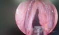 Laryngeal Papillomas Ablation and Vaporization