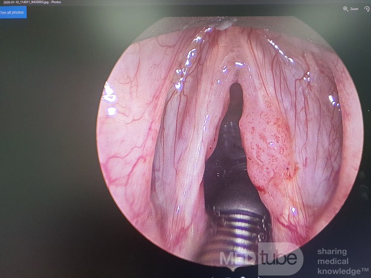 Laryngeal Papillomas Ablation and Vaporization