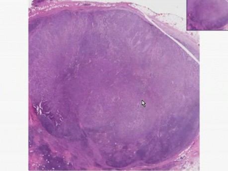 Anaplastic large cell lymphoma - Histopathology - Lymph node