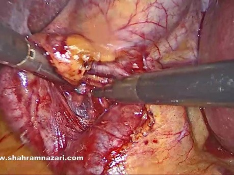 Mirizzi Syndrome Type I