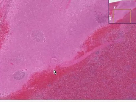Acute infarct - Spleen - Histopathology