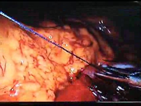 Jejunal Gastrointestinal Stromal tumor (GIST) (67 of 86)