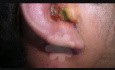 Ramsay Hunt Syndrome