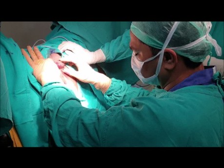 Fistula in Ano Spreading to Testis
