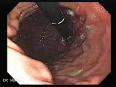 Hourglass Stomach - Ulcers in Retroflexed View