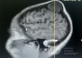 Epicranial Tumor Injury