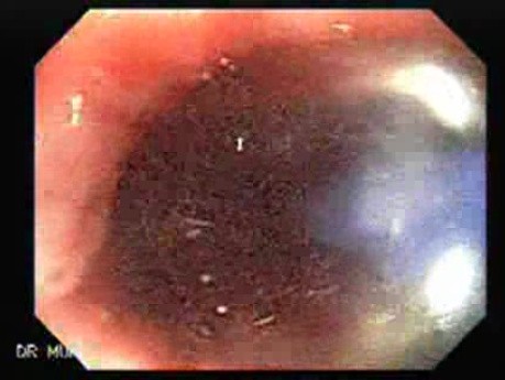 Balloon Dilatation for Esophageal Achalasia