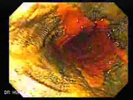 Barrett Esophagus - endoscopic view  (5 of 9)