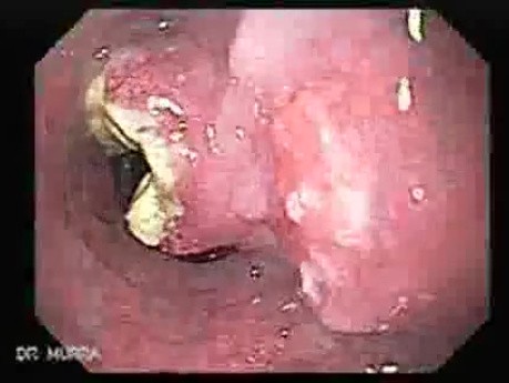 Small cell carcinoma of the lung that invades the upper and the middle third of the Esophagus (4 of 7)